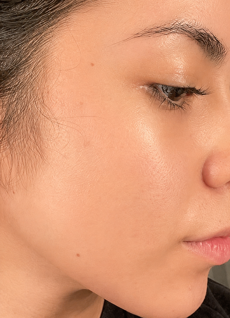After — Anti Acne Luxurious serum